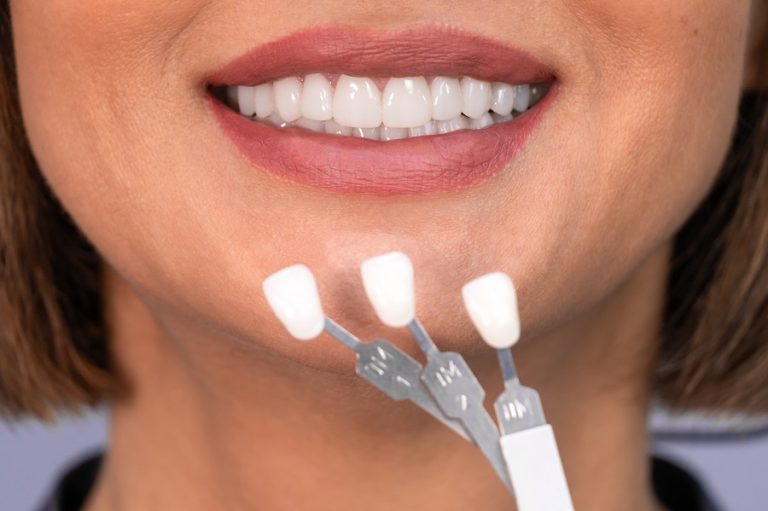 Dental Veneers Can Give You A Brand-New Smile