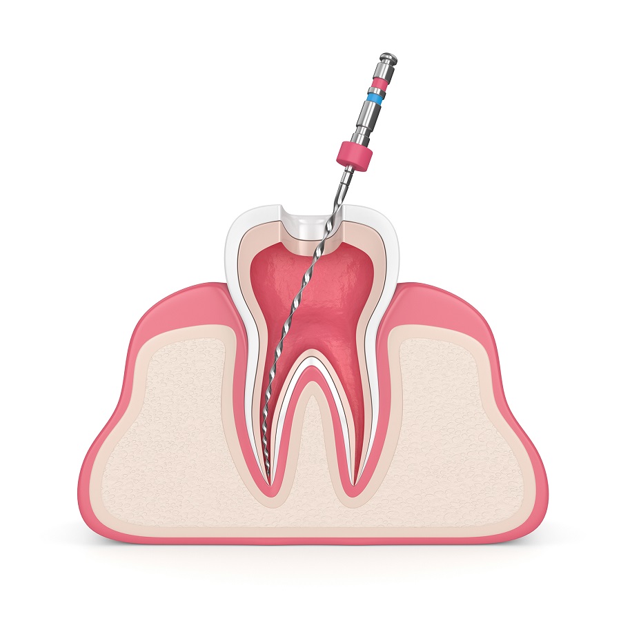 Everything You Need to Know About Getting a Root Canal in Yuma