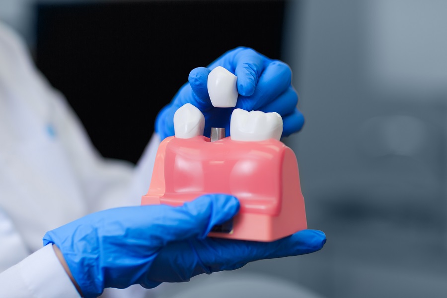 Why are Dental Implants Considered Better than Bridges and Partials?
